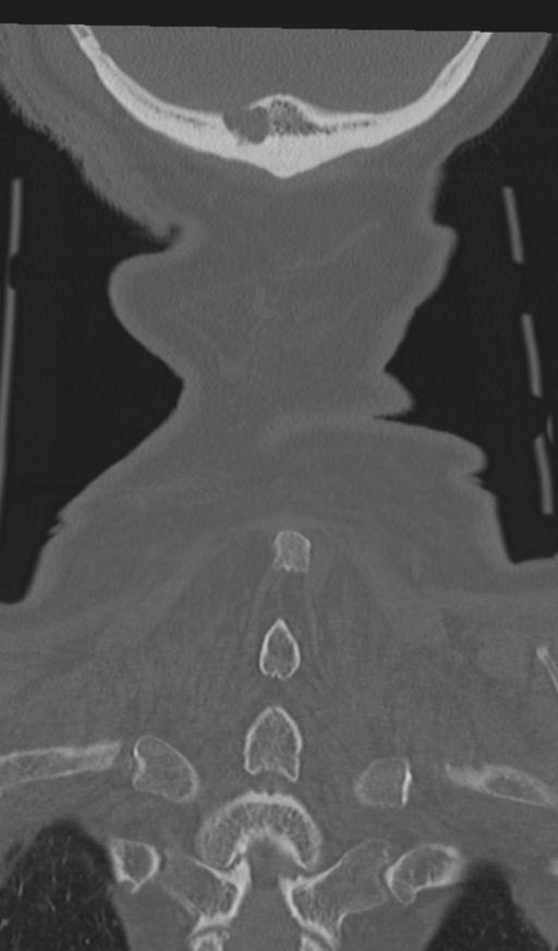Acute on chronic subdural hematoma and thoracic vertebral injury in a multitrauma patient (Radiopaedia 31698-32619 Coronal bone window 65).jpg