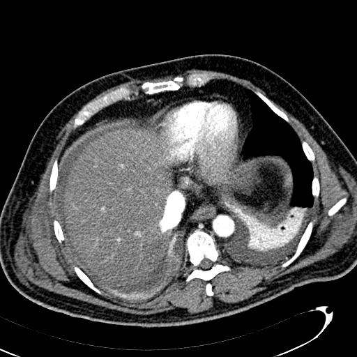 File:Acute pancreatic necrosis (Radiopaedia 13560-13486 Axial C+ portal venous phase 21).jpg