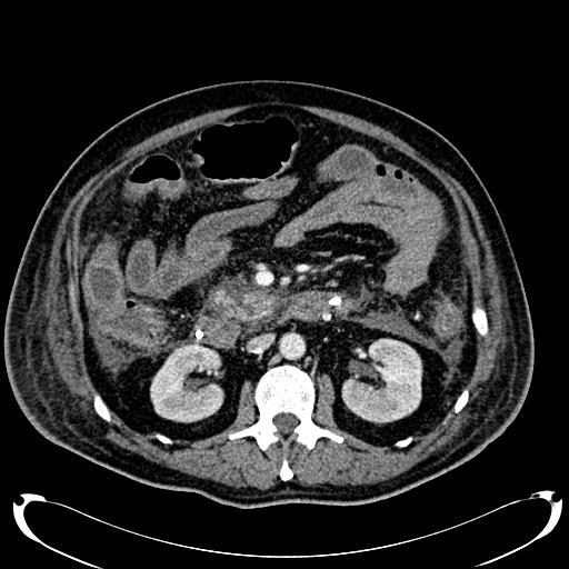 Acute pancreatic necrosis (Radiopaedia 13560-18500 Axial C+ portal venous phase 72).jpg