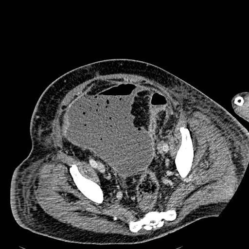 Acute pancreatic necrosis (Radiopaedia 13560-18501 Axial C+ portal venous phase 125).jpg
