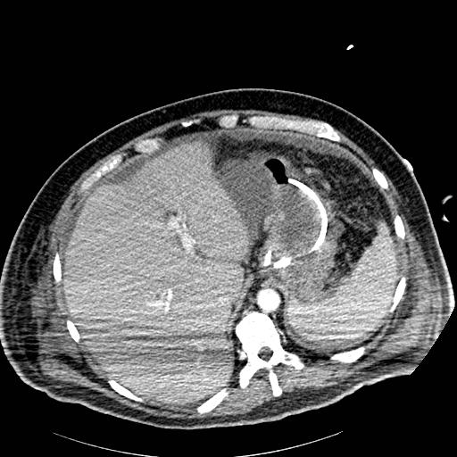 Acute pancreatic necrosis (Radiopaedia 13560-18502 Axial C+ portal venous phase 3).jpg