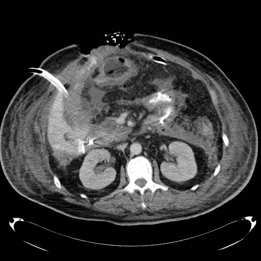 Acute pancreatic necrosis (Radiopaedia 13560-18503 Axial C+ portal venous phase 34).jpg