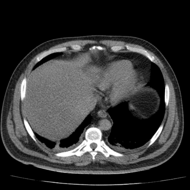 Acute pancreatitis (Radiopaedia 26663-26813 Axial non-contrast 15).jpg