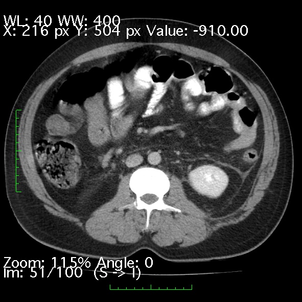 Acute pancreatitis (Radiopaedia 34043-35276 Axial C+ portal venous phase 51).jpg