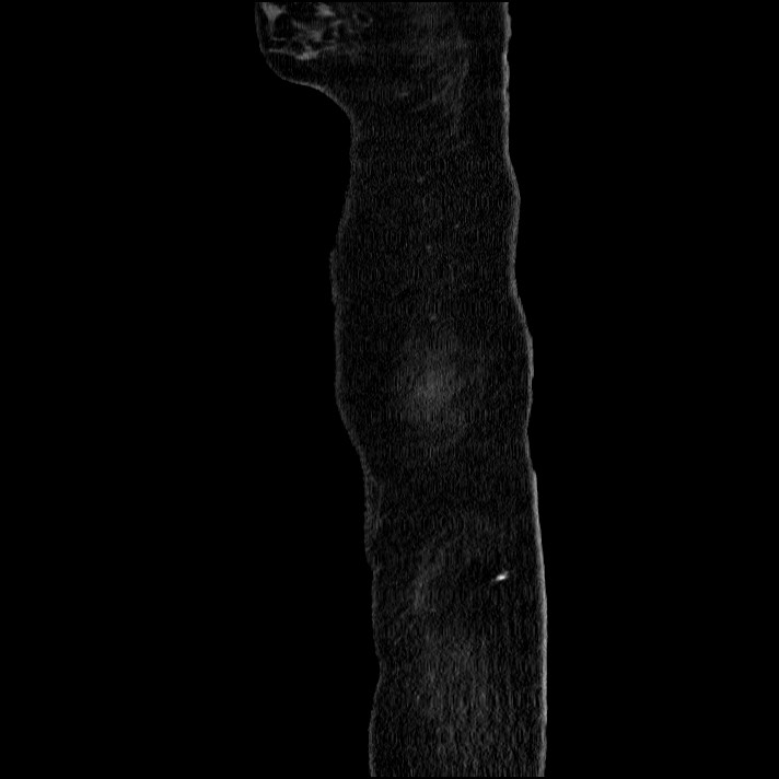 Acute pancreatitis (Radiopaedia 69236-79012 Sagittal C+ portal venous phase 93).jpg