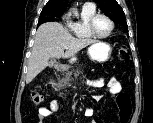 Acute pancreatitis (Radiopaedia 85146-100701 Coronal C+ portal venous phase 22).jpg