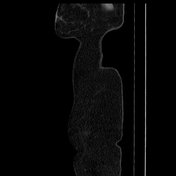 Acute pancreatitis - Balthazar C (Radiopaedia 26569-26714 Sagittal C+ portal venous phase 3).jpg