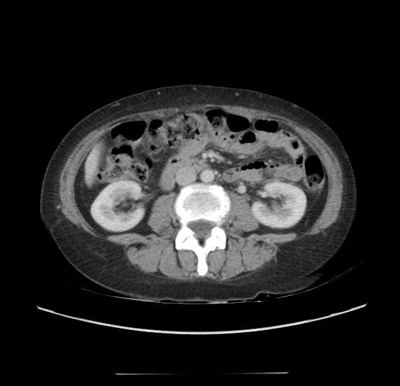 File:Acute pancreatitis - Balthazar E - post ERCP (Radiopaedia 27562-27772 Axial C+ portal venous phase 39).png