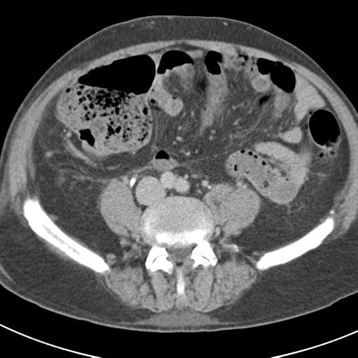 Acute pancreatitis and walled-off necrosis (Radiopaedia 29888-30403 Axial C+ delayed 54).jpg