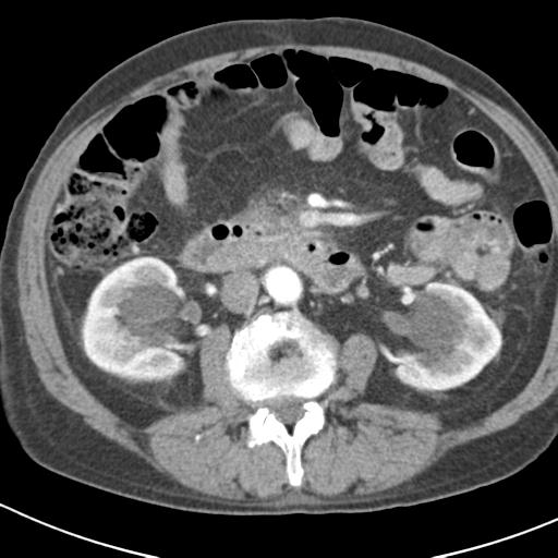 File:Acute pancreatitis and walled-off necrosis (Radiopaedia 29888-30403 Axial C+ portal venous phase 26).jpg