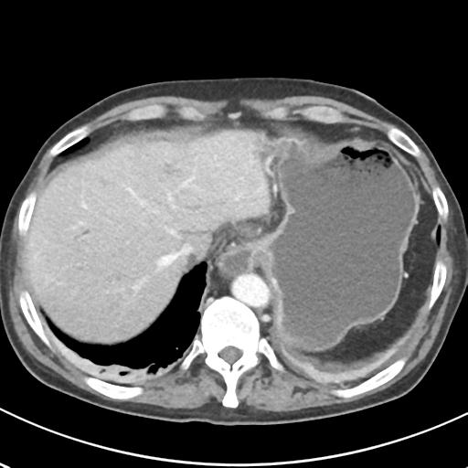 File:Acute pancreatitis and walled-off necrosis (Radiopaedia 29888-30404 Axial C+ portal venous phase 12).jpg