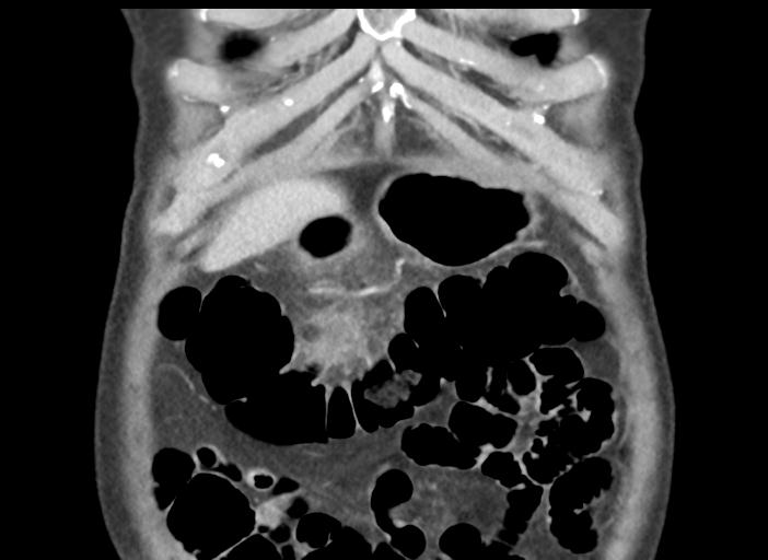 Acute pancreatitis and walled-off necrosis (Radiopaedia 29888-30404 Coronal C+ portal venous phase 10).jpg