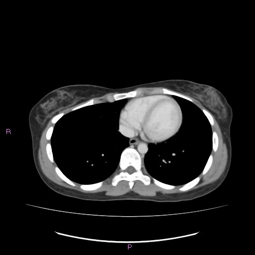 Acute pancreatitis secondary to stone at minor papilla and pancreatic divisum (Radiopaedia 76570-88333 Axial C+ portal venous phase 4).jpg