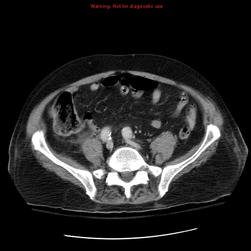 File:Acute pancreatitis with incidental pancreatic lipoma (Radiopaedia 10190-10730 Axial C+ portal venous phase 54).jpg