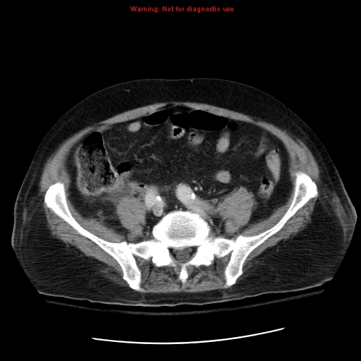 File:Acute pancreatitis with incidental pancreatic lipoma (Radiopaedia 10190-10730 Axial C+ portal venous phase 55).jpg