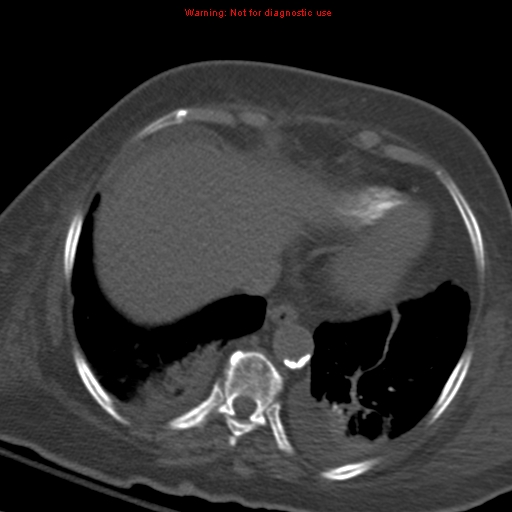 Acute pulmonary embolism (Radiopaedia 13286-13289 Axial C+ CTPA 53).jpg