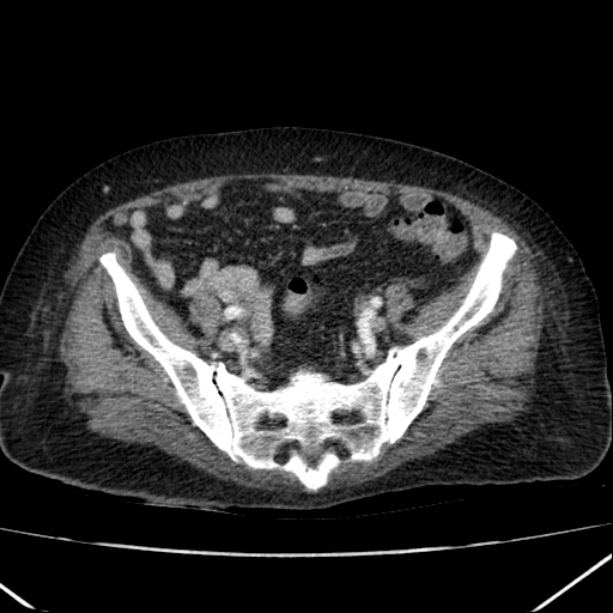 Acute pyelonephritis (Radiopaedia 26584-26729 Axial renal cortical phase 58).jpg