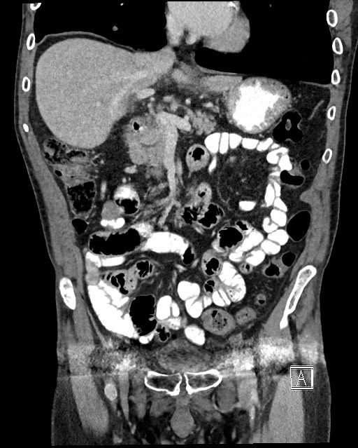 Acute renal infarction - rim capsular enhancement (Radiopaedia 59833-67270 Coronal C+ portal venous phase 13).jpg
