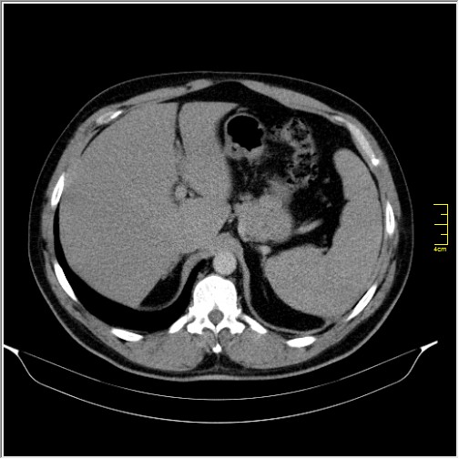 Acute right sided diverticulitis (Radiopaedia 65249-74268 Axial C+ portal venous phase 15).JPG