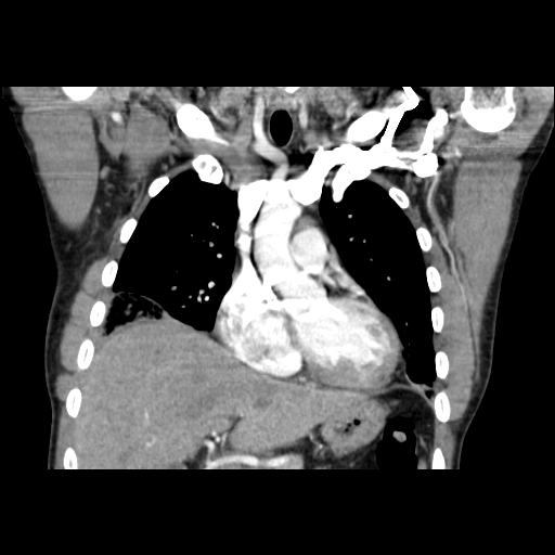 Acute segmental pulmonary emboli and pulmonary infarction (Radiopaedia 62264-70444 Coronal C+ CTPA 17).jpg