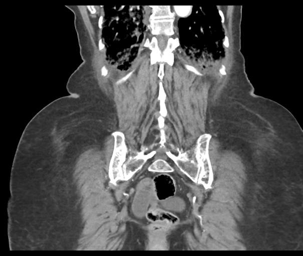 Acute superior mesenteric artery occlusion (Radiopaedia 43926-47418 Coronal C+ portal venous phase 41).png