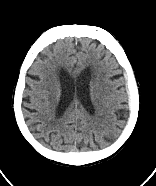Acute traumatic subdural hematoma (Radiopaedia 82921-97257 Axial non-contrast 27).jpg