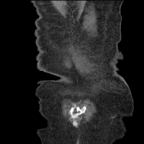 Acute tubular necrosis (Radiopaedia 28077-28334 D 78).jpg