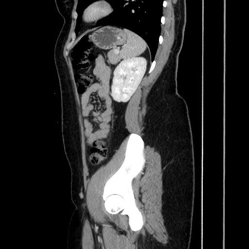 File:Acute uncomplicated appendicitis (Radiopaedia 73704-84499 Sagittal C+ portal venous phase 148).jpg