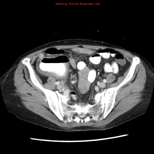 File:Adenocarcinoma of the colon (Radiopaedia 8191-9039 Axial liver window 57).jpg