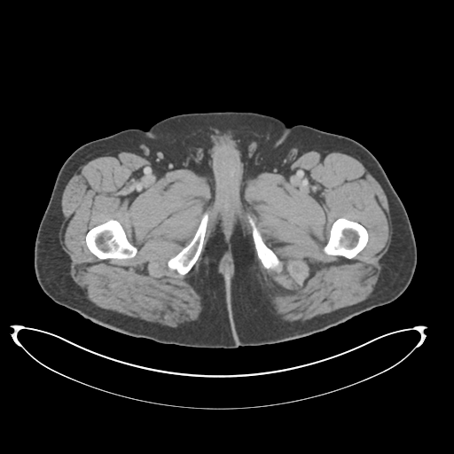 Adenocarcioma of rectum- T1 lesion (Radiopaedia 36921-38547 Axial C+ portal venous phase 98).png