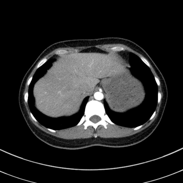 File:Adenocystic carcinoma of the trachea (Radiopaedia 47677-52525 Axial C+ arterial phase 73).jpg