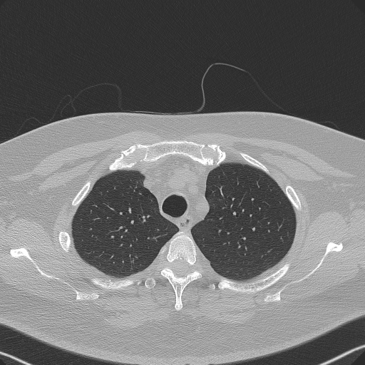 File:Adenoid cystic carcinoma of the trachea (Radiopaedia 49042-54137 Axial lung window 72).jpg