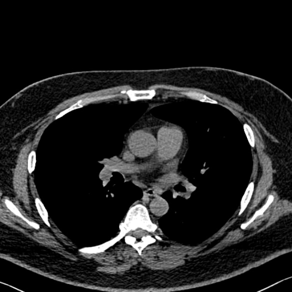 Adenoid cystic carcinoma of the trachea (Radiopaedia 49042-54137 Axial non-contrast 170).jpg