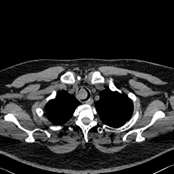 Adenoid cystic carcinoma of the trachea (Radiopaedia 49042-54137 Axial non-contrast 43).jpg