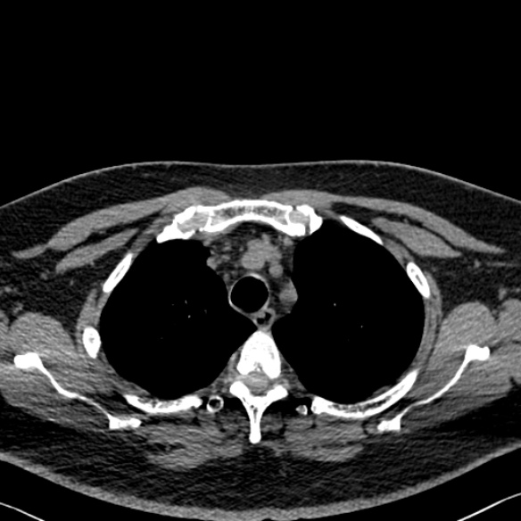 Adenoid cystic carcinoma of the trachea (Radiopaedia 49042-54137 Axial non-contrast 73).jpg