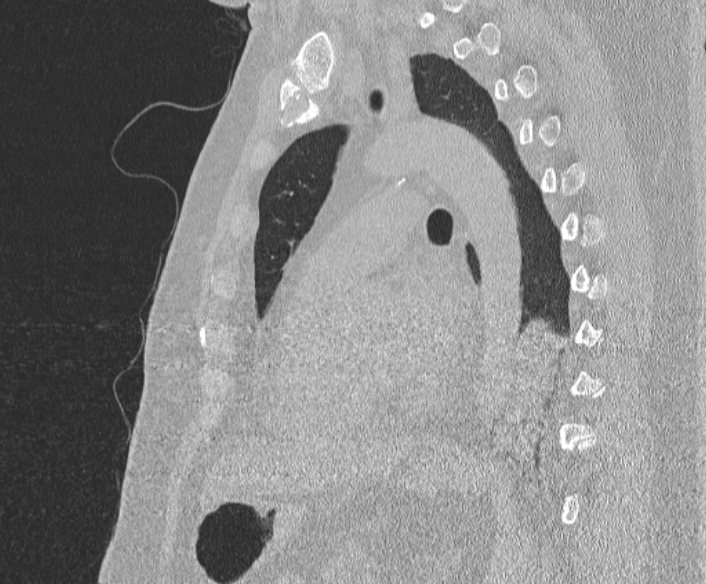 Adenoid cystic carcinoma of the trachea (Radiopaedia 49042-54137 Sagittal lung window 276).jpg