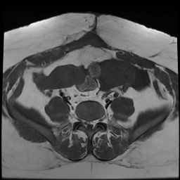 File:Adenomyosis within a didelphys uterus (Radiopaedia 70175-80215 Axial T1 15).jpg