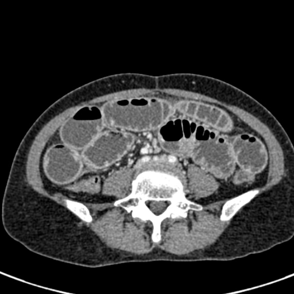 Adhesional small bowel obstruction (Radiopaedia 48397-53305 Axial C+ portal venous phase 56).jpg
