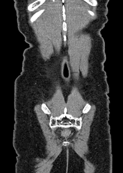Adhesional small bowel obstruction (Radiopaedia 48397-53305 Coronal C+ portal venous phase 325).jpg