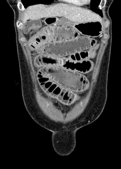 Adhesional small bowel obstruction (Radiopaedia 48397-53305 Coronal C+ portal venous phase 66).jpg