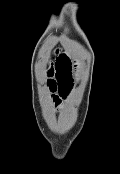 File:Adhesional small bowel obstruction (Radiopaedia 52107-57980 Coronal C+ portal venous phase 5).jpg