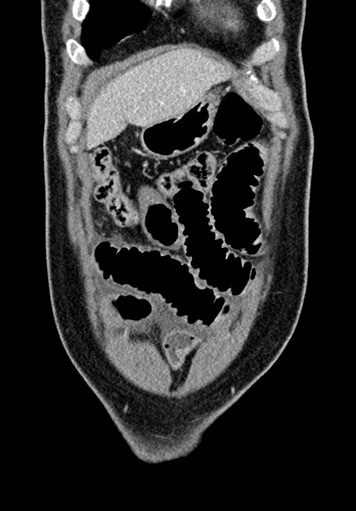 Adhesional small bowel obstruction (Radiopaedia 58900-66131 Coronal C+ portal venous phase 75).jpg