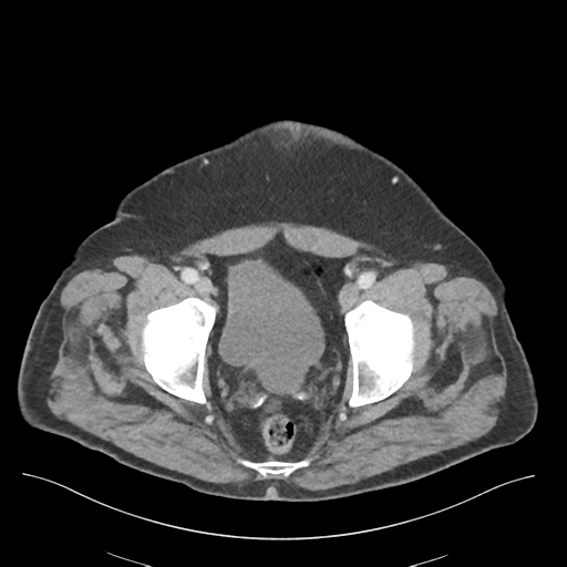 File:Adhesions within abdominal wall hernia (Radiopaedia 58283-65394 Axial C+ portal venous phase 77).png