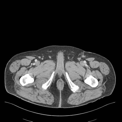 Adhesions within abdominal wall hernia (Radiopaedia 58283-65394 Axial C+ portal venous phase 92).png