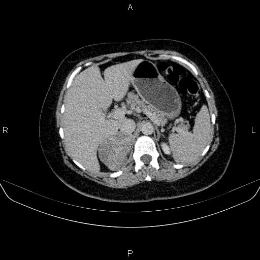 Adrenal cortical carcinoma (Radiopaedia 84882-100379 Axial C+ delayed 22).jpg