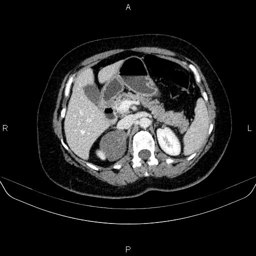 Adrenal cortical carcinoma (Radiopaedia 84882-100379 Axial C+ portal venous phase 29).jpg