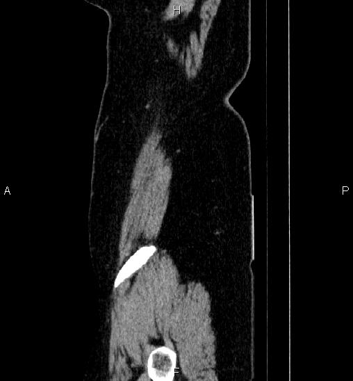 Adrenal cortical carcinoma (Radiopaedia 84882-100379 Sagittal C+ portal venous phase 86).jpg