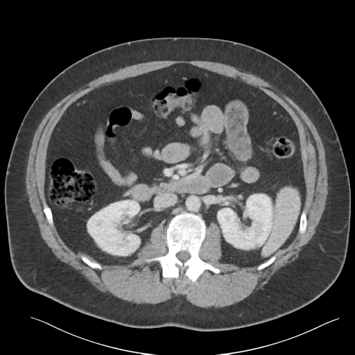 File:Adrenal cyst (Radiopaedia 45625-49777 Axial C+ portal venous phase 45).png