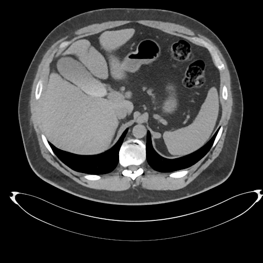 File:Adrenal cyst (Radiopaedia 45625-49778 Axial non-contrast 23).png