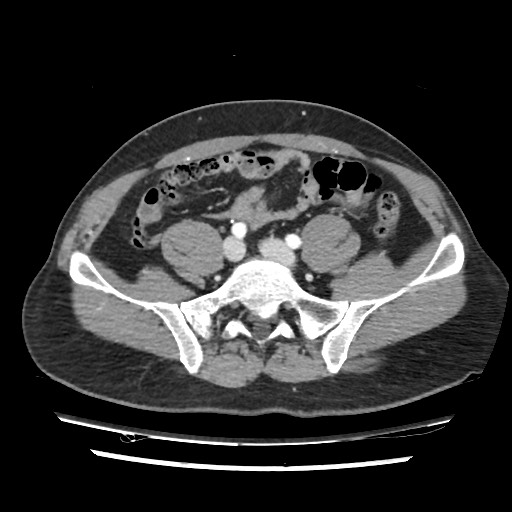 Adrenal gland trauma (Radiopaedia 81351-95078 Axial Dual bolus trauma C+ 97).jpg